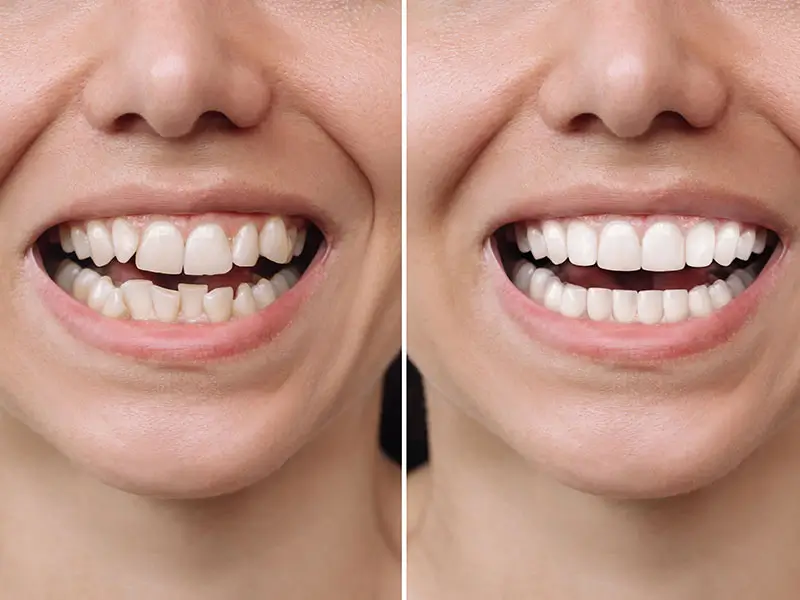 Antes y después. Apiñamiento dental. Corregido con Ortodoncia en Ciutat Vella