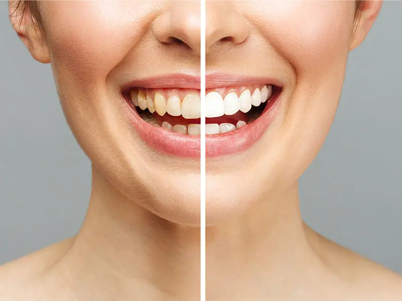 blanqueamiento-dental-valencia-ciutat-vella Implantes Dentales