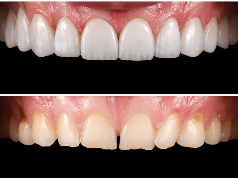 carillas-dentales-antes-despues-valencia-ciutat-vella Implantes Dentales