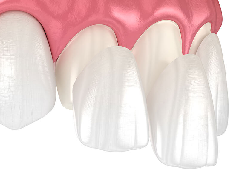 carillas-dentales-valencia-ciutat-vella