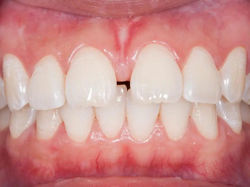 Separación de dientes (diastema)