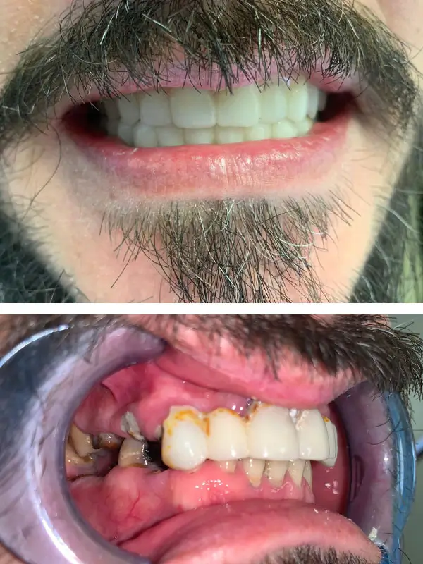 Implantes Dentales
