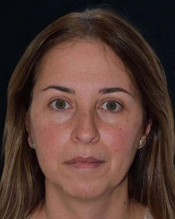 Armonización Orofacial - antes Armonización Orofacial - antes