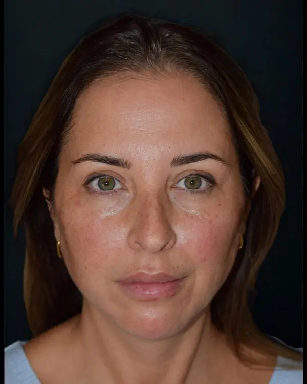 Armonización Orofacial - después Armonización Orofacial - después